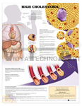 High Cholesterol Anatomical Chart